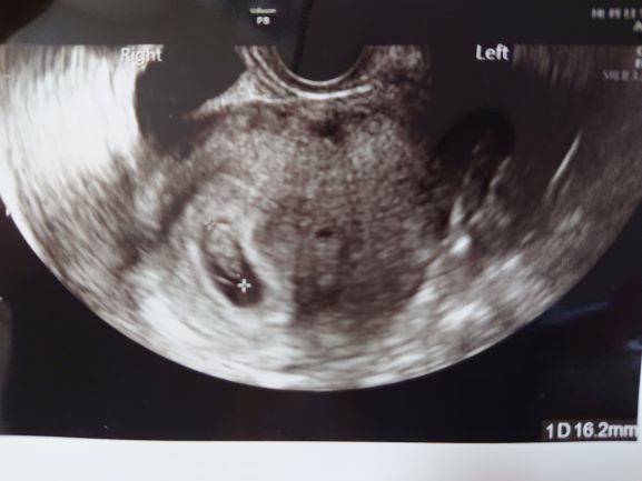 エコー、心拍確認、胎芽、胎嚢、GS、CRL、BT34、7週4日